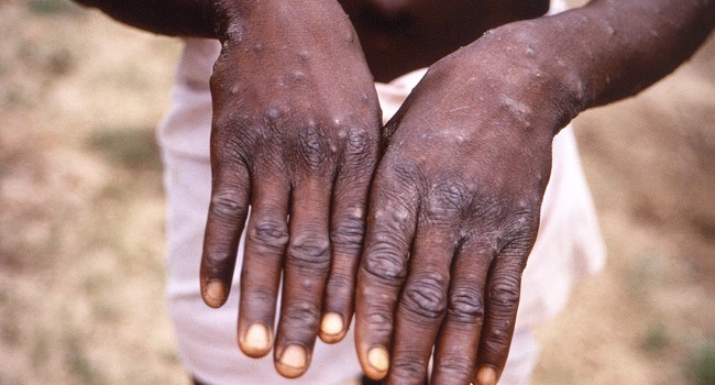 Monkeypox