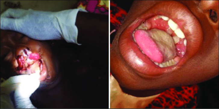 Diphtheria Cases Rises To 216 Infected In Nigeria