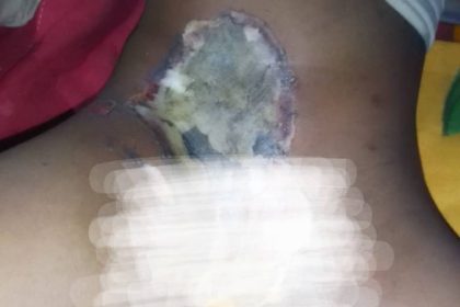 Woman Burns 7-Year-Old Girl’s Private Part With Hot Knife Over Witchcraft Allegation