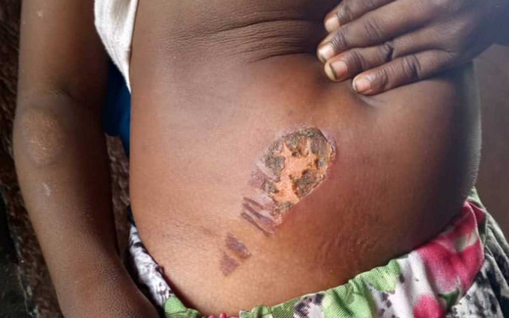 Bauchi Police Arrest Stepmother for Burning 5-Year-Old Over Bedwetting