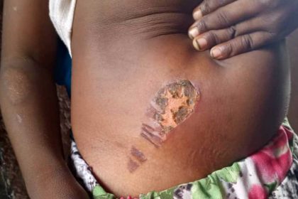Bauchi Police Arrest Stepmother for Burning 5-Year-Old Over Bedwetting