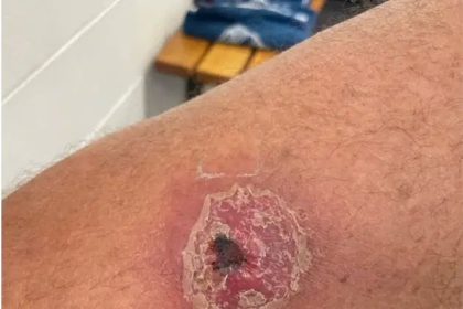 FG Investigates Strange Flesh-Eating Disease in Adamawa