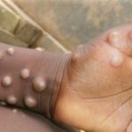 Africa Records Over Mpox Cases