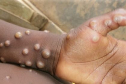 Africa Records Over Mpox Cases