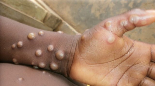 Africa Records Over Mpox Cases