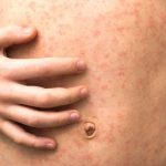 Measles Outbreak Infects 34 Children in North London Schools
