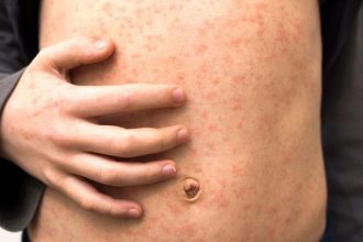 Measles Outbreak Infects 34 Children in North London Schools