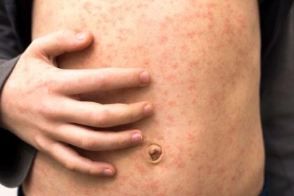 Measles Outbreak Infects 34 Children in North London Schools