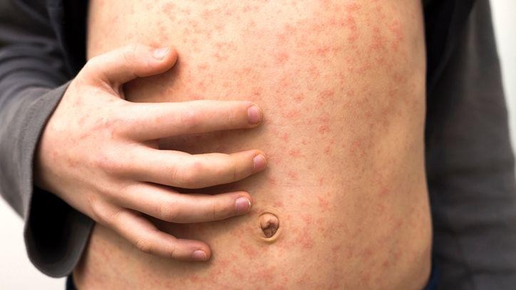 Measles Outbreak Infects 34 Children in North London Schools