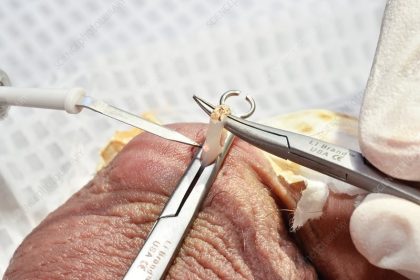 Vasectomy in Africa: The Silent Struggle Between Culture and Choice