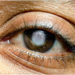 Lagos Residents Advised to Undergo Routine Tests for Glaucoma
