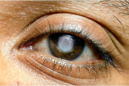 Lagos Residents Advised to Undergo Routine Tests for Glaucoma