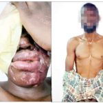 Man Allegedly Receives N500,000 For Acid Attack, Injures Wrong Victim