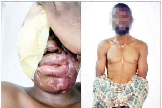Man Allegedly Receives N500,000 For Acid Attack, Injures Wrong Victim