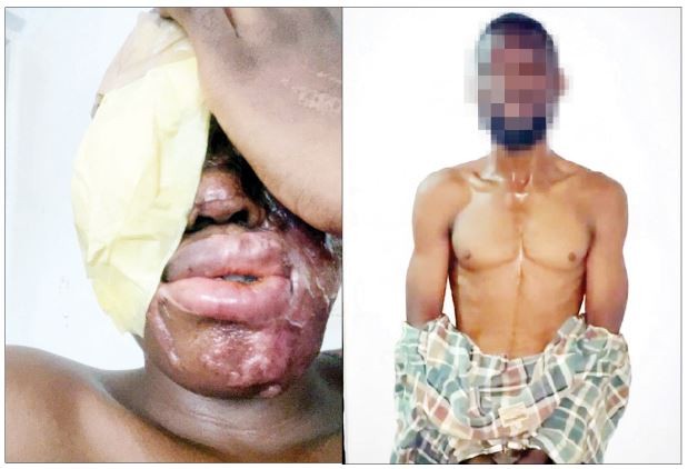 Man Allegedly Receives N500,000 For Acid Attack, Injures Wrong Victim